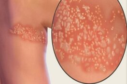 Giời Leo: Từ Nguyên Nhân Đến Cách Điều Trị Hiệu Quả