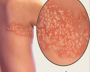 Giời Leo: Từ Nguyên Nhân Đến Cách Điều Trị Hiệu Quả