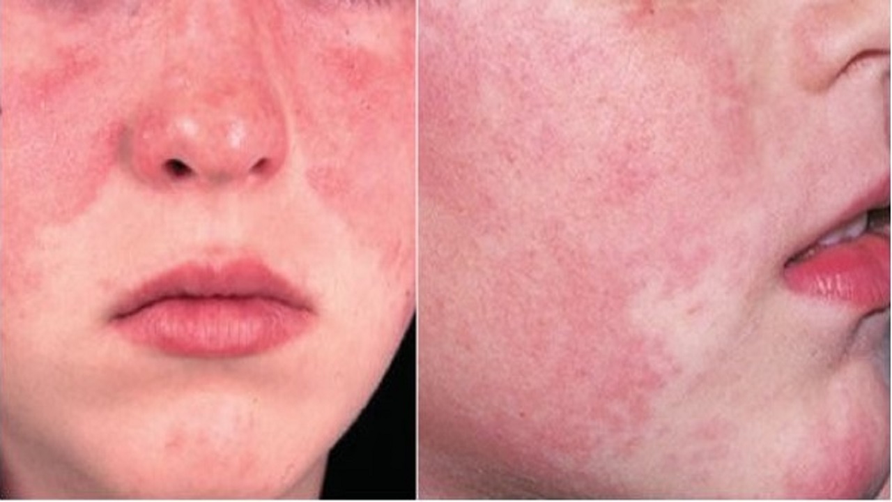lupus ban đỏ