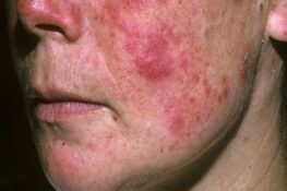 Tất Tần Tật Về Lupus Ban Đỏ: Từ Chẩn Đoán, Dấu Hiệu Đến Chế Độ Ăn Uống