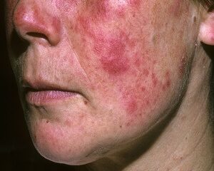 Tất Tần Tật Về Lupus Ban Đỏ: Từ Chẩn Đoán, Dấu Hiệu Đến Chế Độ Ăn Uống