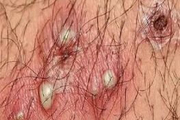 Mụn Ở Vùng Kín: Dấu Hiệu, Nguyên Nhân Và Cách Phòng Ngừa