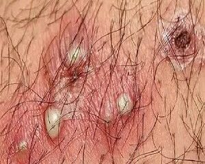 Mụn Ở Vùng Kín: Dấu Hiệu, Nguyên Nhân Và Cách Phòng Ngừa