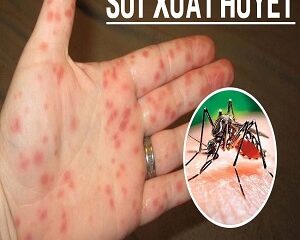 Sốt Xuất Huyết Có Nguy Hiểm Không? Cách Điều Trị Hiệu Quả