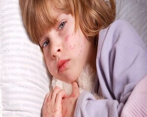 Da Nổi Mẩn Đỏ Ngứa: Nguyên Nhân và Cách Xử Lý