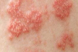 Zona Thần Kinh Là Bệnh Gì? Dấu Hiệu Nhận Biết và Cách Phòng Ngừa