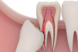Nhổ Răng Khôn Có Đau Không? Quy Trình Và Cách Chăm Sóc Hiệu Quả