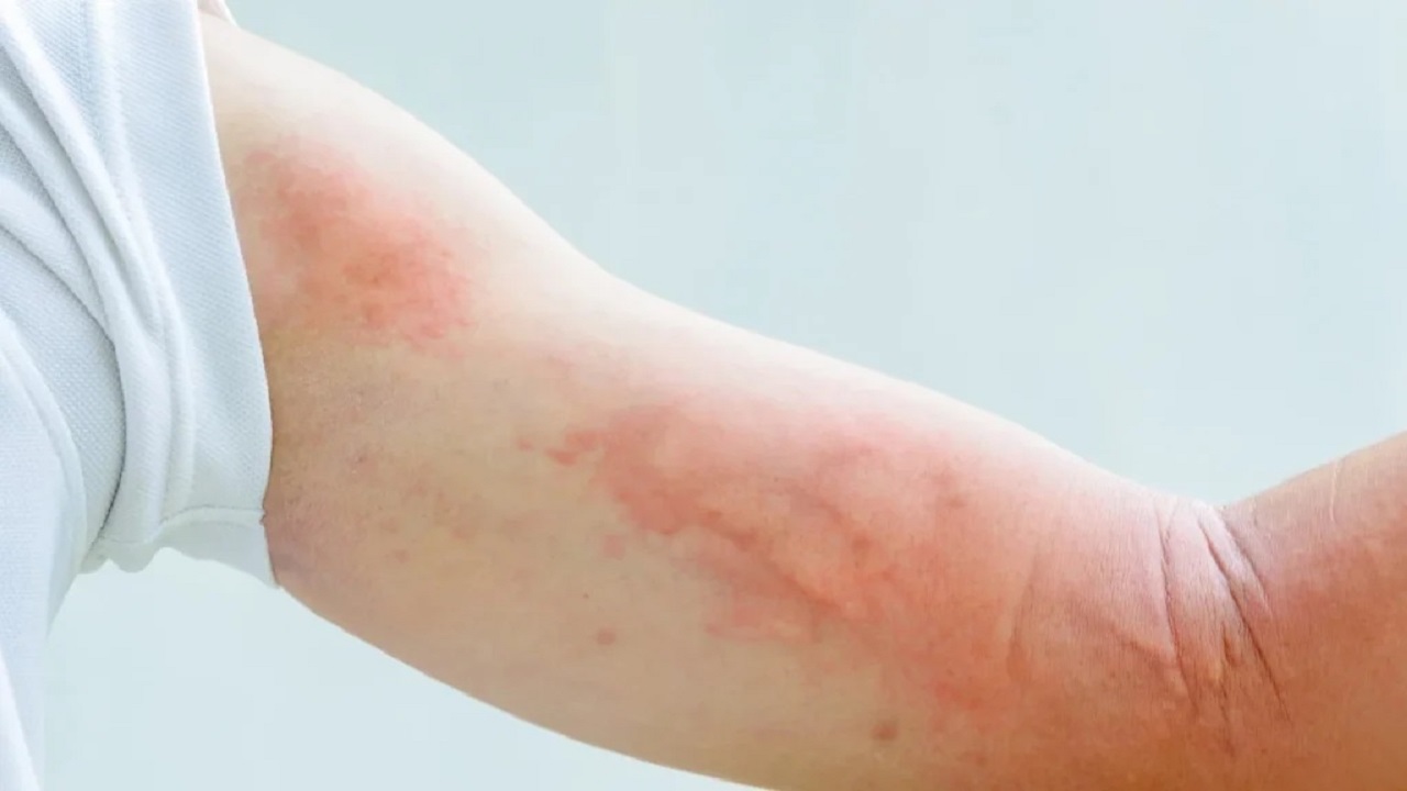 bị nổi mề đay