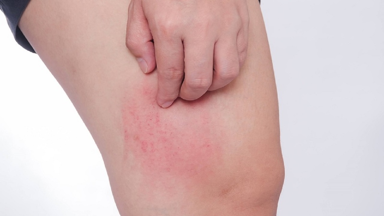 bị nổi mề đay