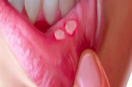 Nhiệt Miệng: Nguyên Nhân, Triệu Chứng Và Cách Điều Trị Hiệu Quả