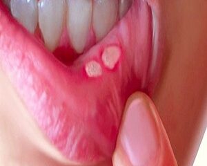 Nhiệt Miệng: Nguyên Nhân, Triệu Chứng Và Cách Điều Trị Hiệu Quả