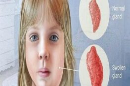 Quai Bị Là Gì? Dấu Hiệu Nhận Biết, Biến Chứng Và Phòng Tránh