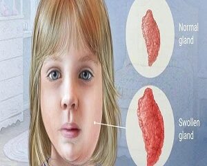 Quai Bị Là Gì? Dấu Hiệu Nhận Biết, Biến Chứng Và Phòng Tránh