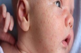 Tại Sao Bị Mề Đay? Các Yếu Tố Gây Bệnh Bạn Cần Biết