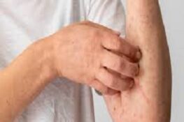 Tất Tần Tật Về Viêm Da Cơ Địa: Nguyên Nhân, Điều Trị và Bí Quyết Phòng Tránh