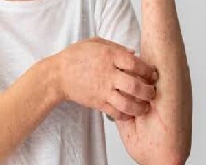 Tất Tần Tật Về Viêm Da Cơ Địa: Nguyên Nhân, Điều Trị và Bí Quyết Phòng Tránh