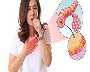 Viêm Phế Quản: Tất Tần Tật Về Nguyên Nhân, Triệu Chứng Và Cách Điều Trị Hiệu Quả