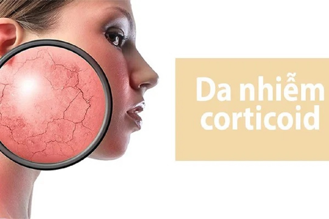 Corticoid là gì