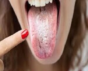 Tất Tần Tật Về Nấm Candida: Nguyên Nhân và Cách Khắc Phục