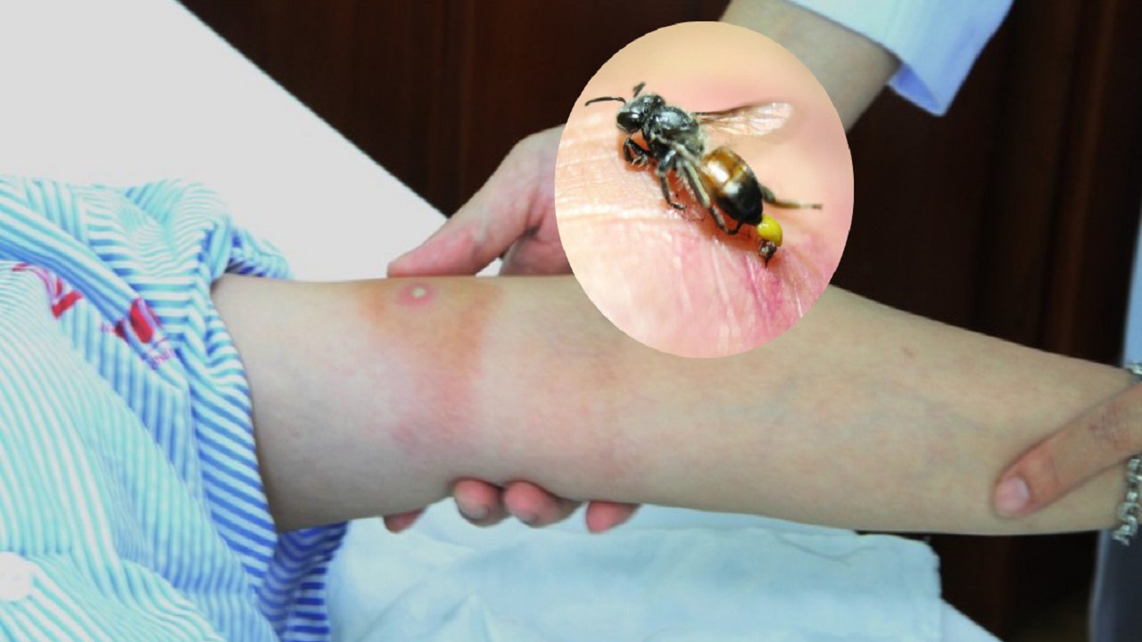 bị ong đốt nên làm gì