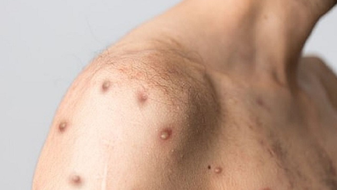 dấu hiệu hiv