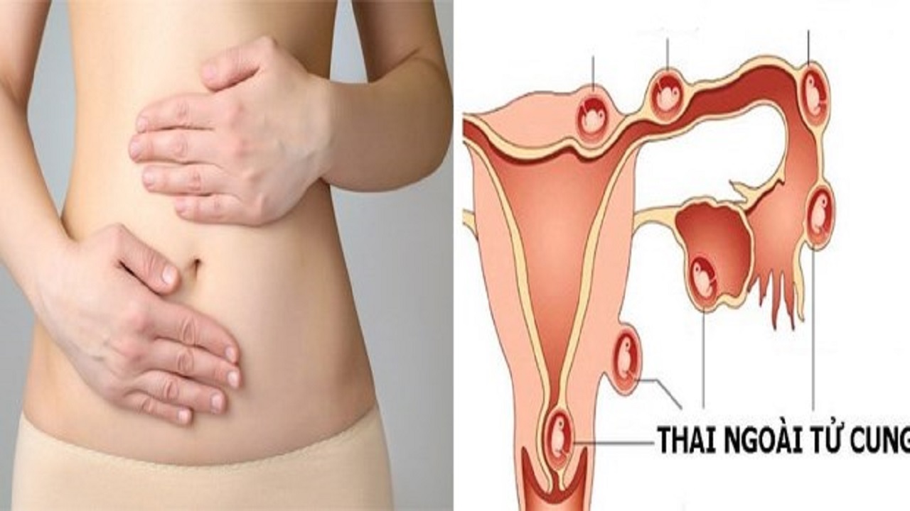 dấu hiệu mang thai