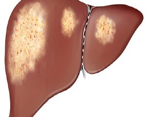 Gan Nhiễm Mỡ Có Nguy Hiểm Không? Phương Pháp Điều Trị Hiệu Quả