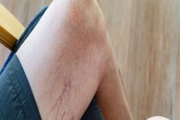 Giãn Tĩnh Mạch: Triệu Chứng, Nguyên Nhân và Cách Xử Lý Hiệu Quả