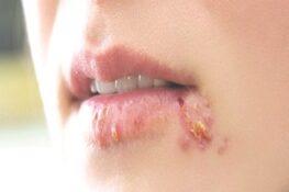 Herpes ở Môi: Những Điều Bạn Cần Biết Để Phòng Ngừa và Điều Trị