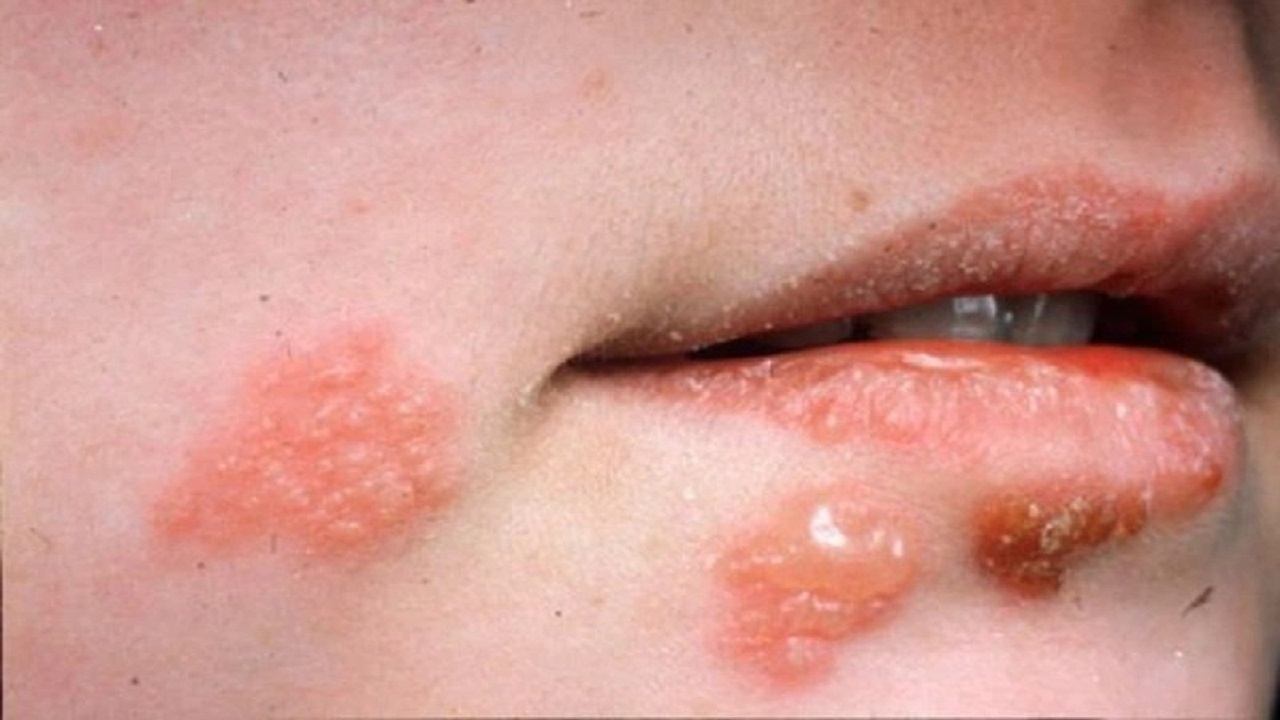 herpes môi