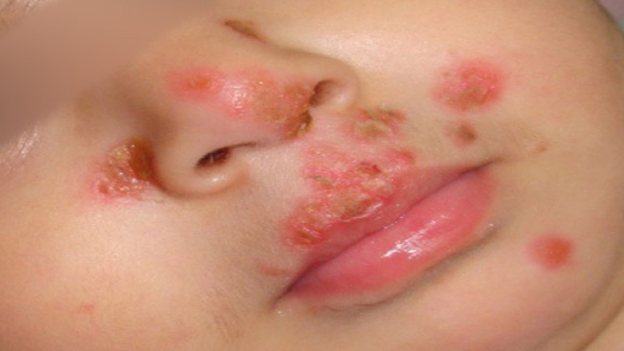 herpes môi