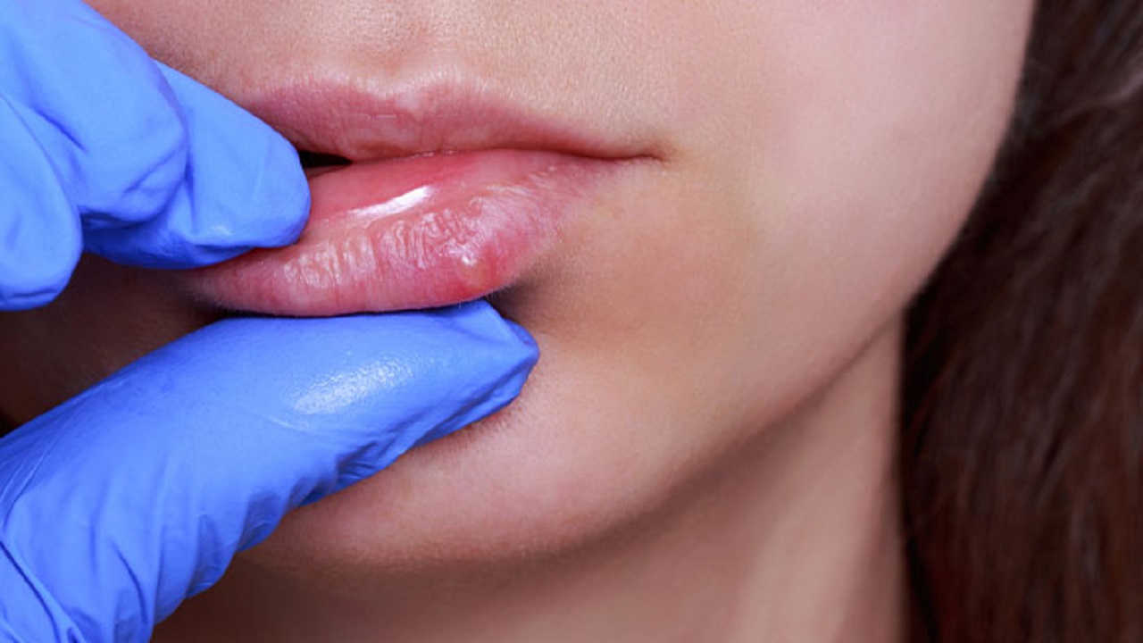 herpes môi