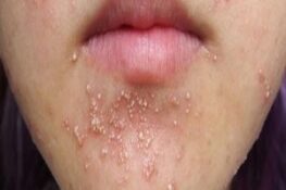 Nổi Mụn Nước: Nguyên Nhân, Biểu Hiện và Cách Điều Trị Hiệu Quả