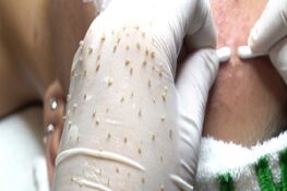 Có nên nặn mụn? Lợi ích và tác hại bạn cần biết