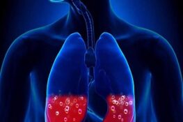 Nguyên Nhân Phù Phổi Cấp và Cách Điều Trị Hiệu Quả