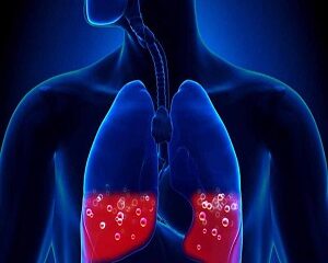 Nguyên Nhân Phù Phổi Cấp và Cách Điều Trị Hiệu Quả