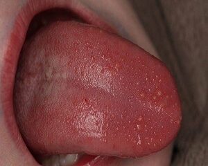 Hiểu Rõ Về Sùi Mào Gà: Nguyên Nhân, Dấu Hiệu và Cách Điều Trị Tốt Nhất