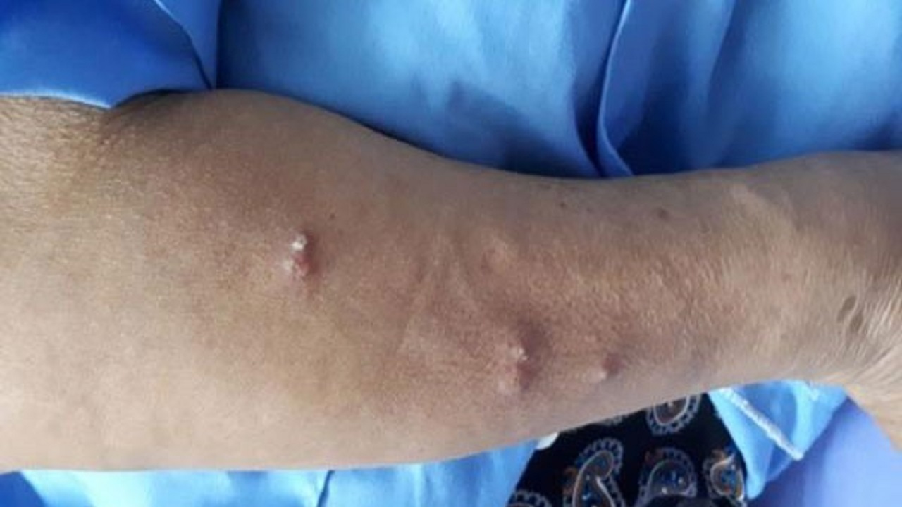 vi khuẩn ăn thịt người