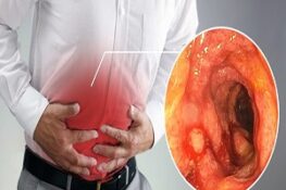 Viêm Đại Tràng: Nguyên Nhân, Triệu Chứng và Cách Phòng Ngừa