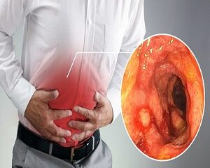 Viêm Đại Tràng: Nguyên Nhân, Triệu Chứng và Cách Phòng Ngừa
