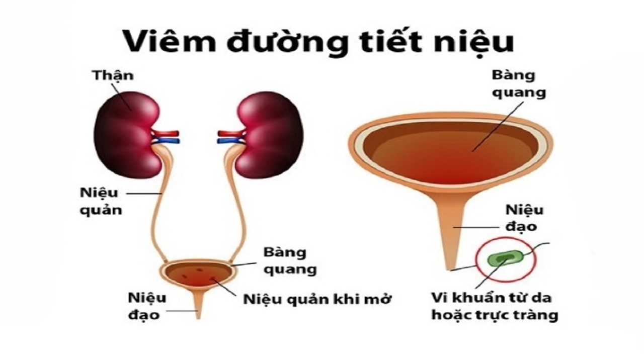 viêm đường tiết niệu
