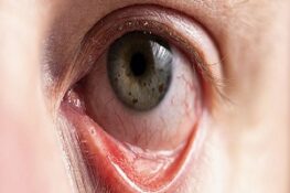 Bệnh Viêm Kết Mạc Mắt: Nguyên Nhân, Triệu Chứng và Cách Điều Trị