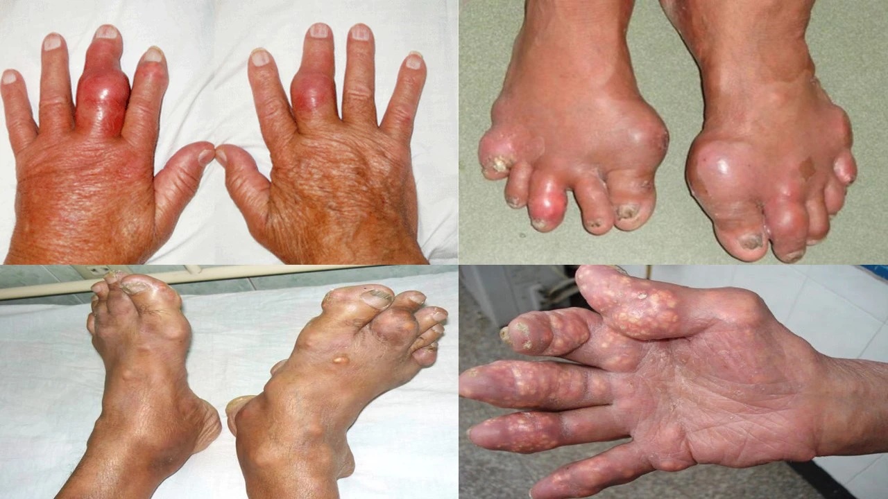 bệnh gout