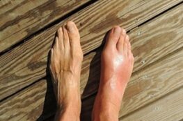 Bệnh Gout là gì? Nguyên nhân, triệu chứng và cách nhận diện sớm
