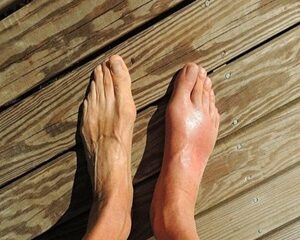 Bệnh Gout là gì? Nguyên nhân, triệu chứng và cách nhận diện sớm