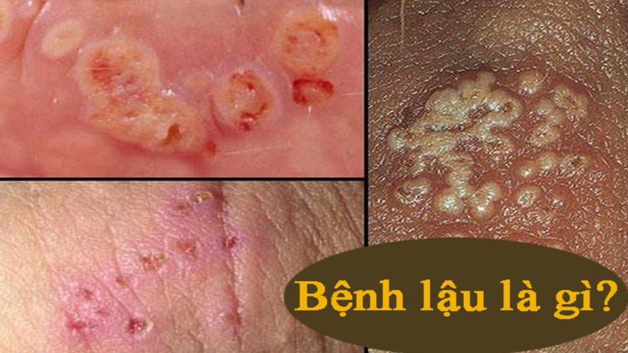 bệnh lậu