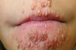 Bệnh Lậu là gì? Nguyên nhân, triệu chứng và cách điều trị hiệu quả