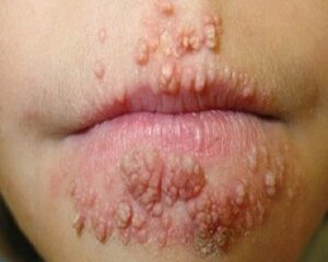 Bệnh Lậu là gì? Nguyên nhân, triệu chứng và cách điều trị hiệu quả
