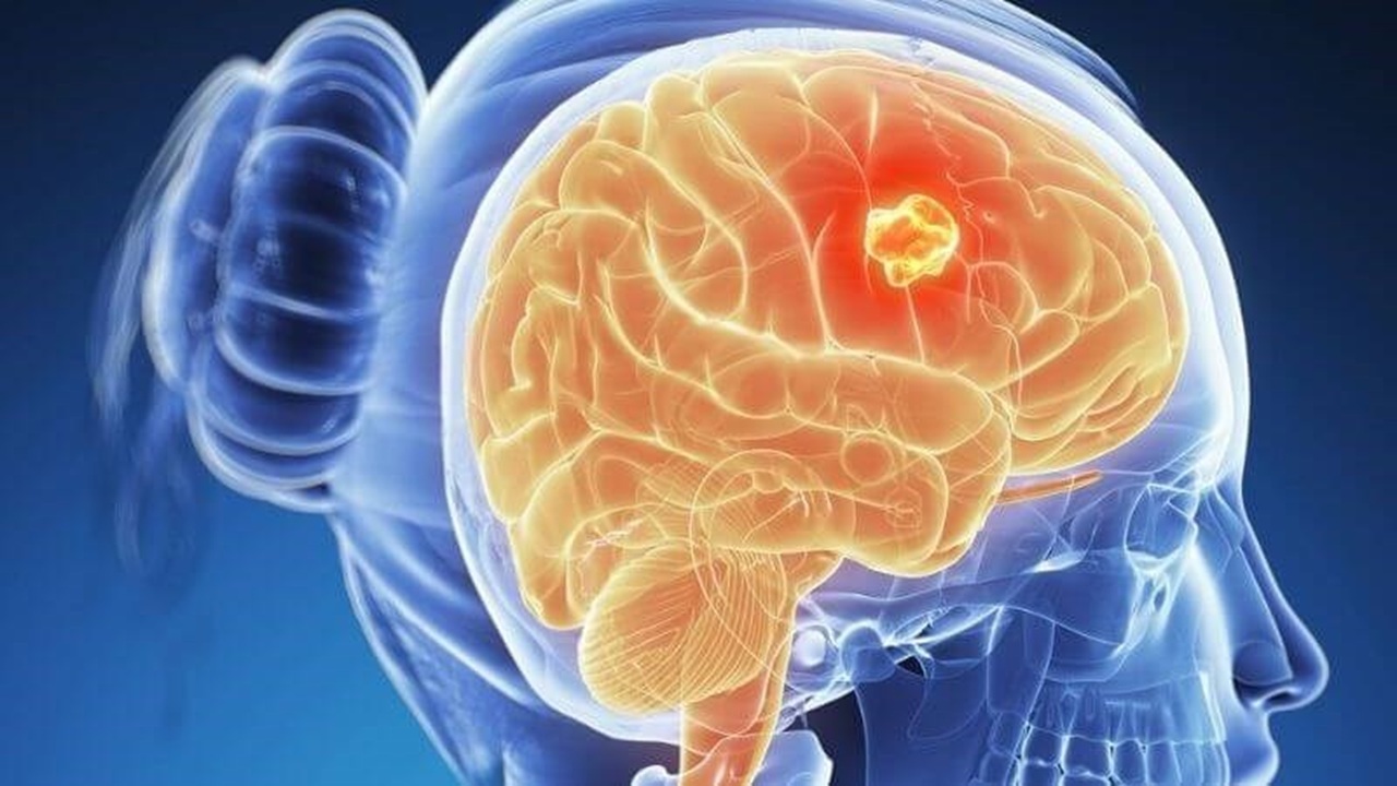 bệnh u não là gì