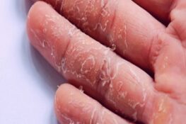 Làm Thế Nào Để Điều Trị Khi Tay Bị Tróc Da?